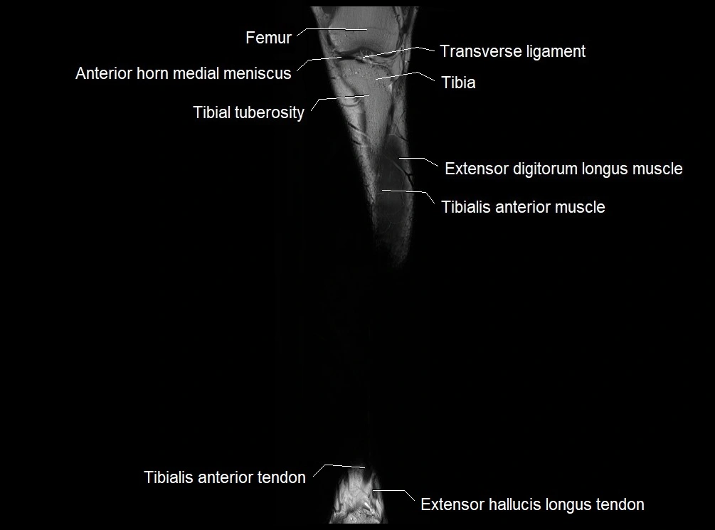 MRI 3T leg (tibia & fibula) labelled coronal cross sectional anatomy image 7.webp